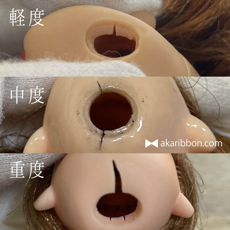 軽度〜重度の比較